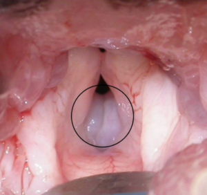 Everted laryngeal saccules