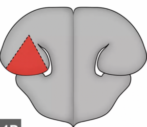 Wedge Alarplasty